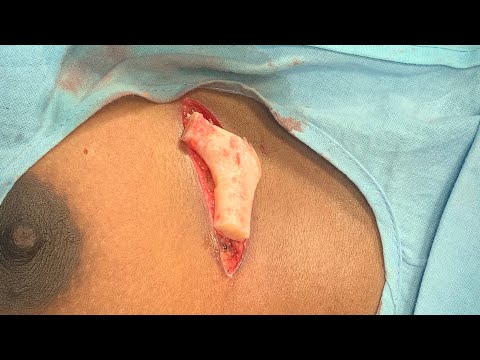 Breast Augmentation Type Scarless Incision And Technique For Large Cartilaginous Rib Harvest