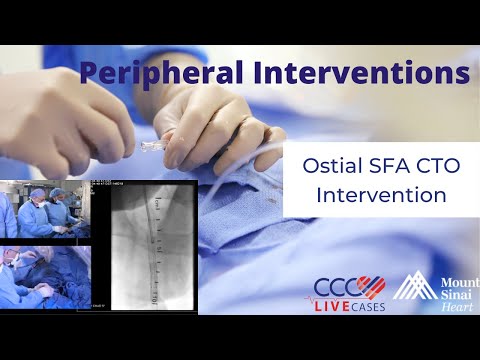 Ostial SFA CTO Intervention - April 22, 2019