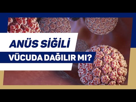 Anüs Siğili Nedir? Neden Olur? Vücuda Bulaşır Mı? Anüs Siğilleri Tedavi Seçenekleri