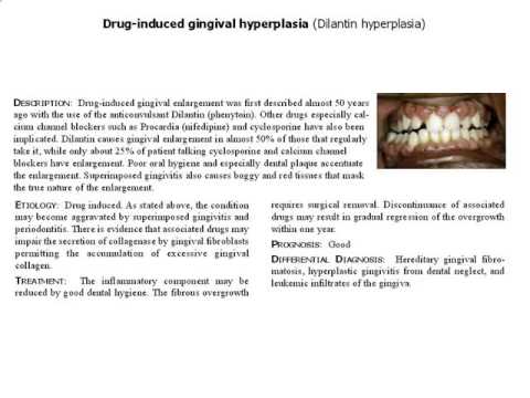 drug induced gingival hyperplasia