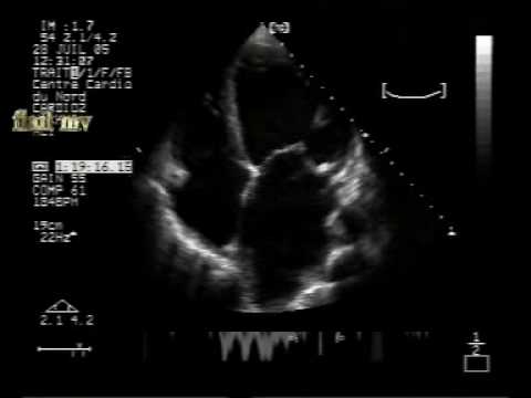 Flail Mitral Valve With Severe Mitral Regurgitation (1/2)