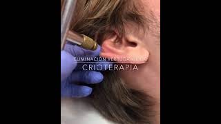Cómo se elimina una verruga vírica mediante el uso de la crioterapia.
