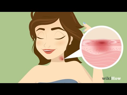 How to Give Someone a Hickey