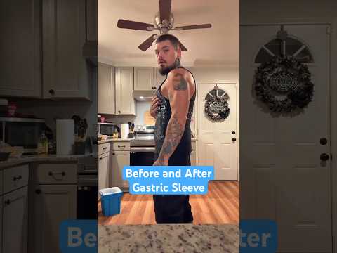Before and After Gastric Sleeve!! 🔥