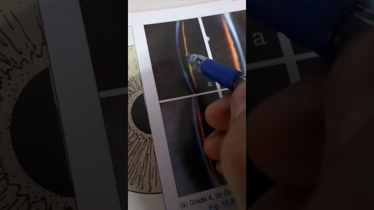 Van Herick's slit lamp grading test simplified