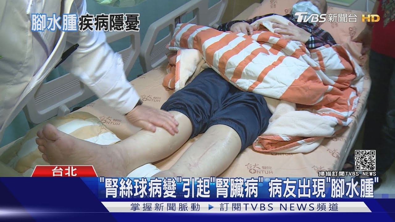 不得輕忽!這四種疾病導致「腳水腫」 醫師:勿拖延!