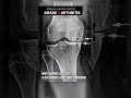 Knee Arthritis Mild To Severe To NEW Shorts
