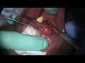 Removal of a HUGE salivary stone by Cherry Hill.