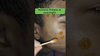 🔥 Acne treatment at home 💯|How to Get rid of acne  in overnight| #shorts #skincare #pimplefree