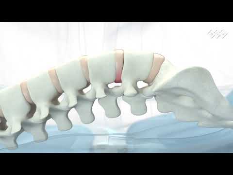 096 496 BTL 6000 Traction BTL Spinal Decompression Mechanism of action video EN100