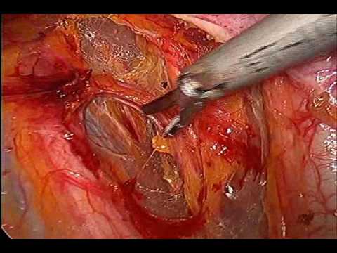 Laparoskopische radikale Hysterektomie mit Biopsie paraaortaler Lymphknoten
