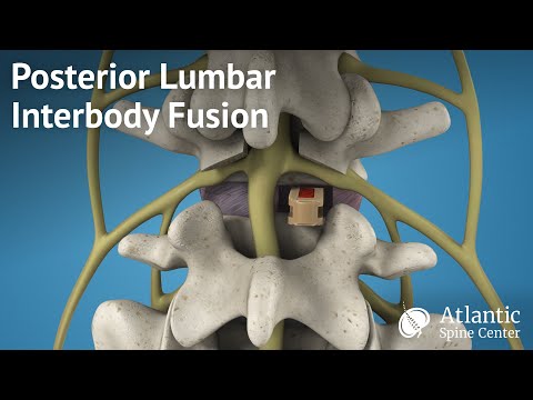 PLIF Procedure Overview