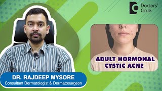 ADULT HORMONAL CYSTIC ACNE. Causes & Treatment from Dermatologist-Dr.Rajdeep Mysore| Doctors