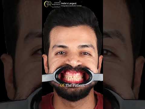 Smile Transformation Explained | Cosmetic Dentistry & Aesthetic Smile Design | Cosmo Radiance