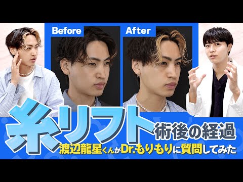 【糸リフトBefore･After】渡辺龍星くんがDr.もりもりに質問してみた【種類は？長持ちさせるには？】