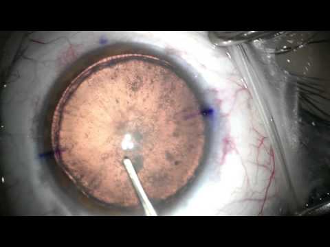 Capsulorhexis Curvilínea Contínua (CCC) en un Paciente con una Megalocornea