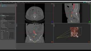 DeepDRR ImFusion Suite Framework Plugin