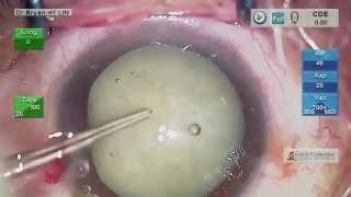 Complicated cataract surgery:Milky white but very dense NS by chop and without using staining -8