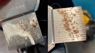 Close-Up Of Lice Infestation Removal