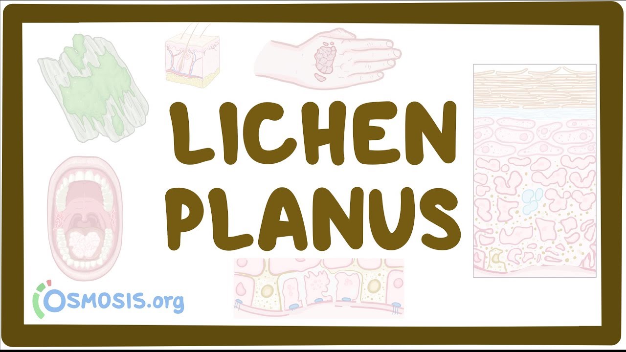 Lichen planus - causes, symptoms, diagnosis, treatment, pathology