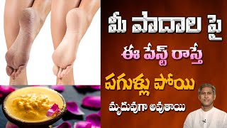 How to Treat Cracked Heels at Home | Tips to Get Smooth & Beautiful Feet | Dr.Manthena's Health Tips