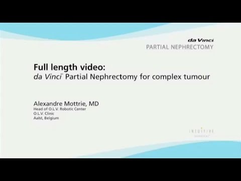 daVinci Partial Nephrectomy for complex tumour