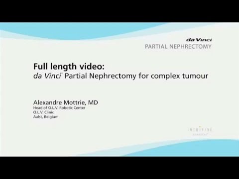 daVinci Partial Nephrectomy for complex tumour