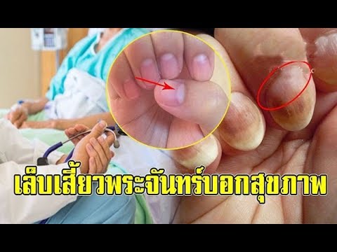 การฉีดการแสดงความคิดเห็นเป็นโรคสะเก็ดเงิน โรคสะเก็ดเงินรักษาหัวแชมพู