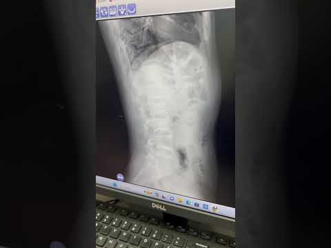 OMG Broken Back!#chiropractic #gentlechiropractor #asmr #trendingshorts