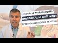 Bile Acid Malabsorption and Bile Acid Deficiency After Gallbladder Removal – What You Need to Know