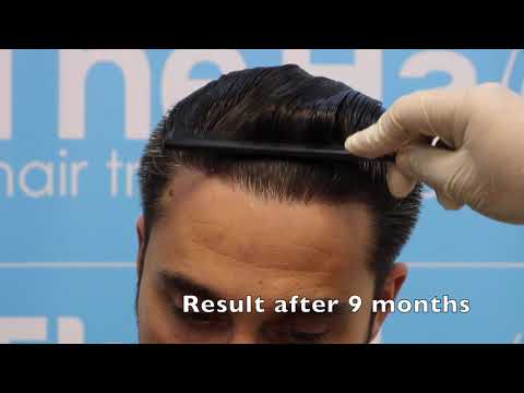 HAIRLINE RECONSTRUCTION BY DR ARSHAD FRCS