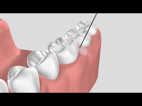 Quicksleeper5 Intraosseous Anaesthesia Device