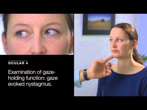Examination of Gaze Holding Deficit Gaze Evoked Nystagmus