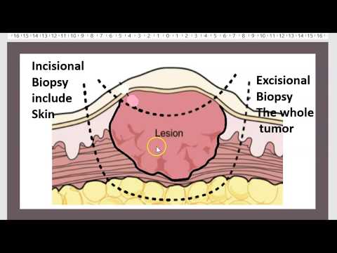 que es papilomatosis ductal