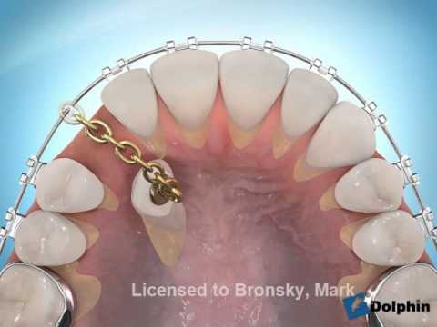 Conseil vidéo orthodontie