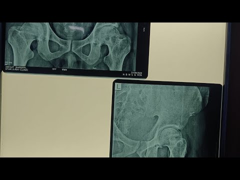 Orthopaedic Surgeries||Dr K K Subbaiah