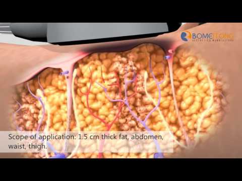 Show--Ultrashape Focused Ultrasound Fat Removal USV3---  Beijing Bomeitong Technology Co., Ltd