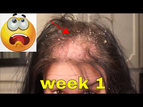 download lagu mp3 mp4 Is Garlic Good For Hair, download lagu Is Garlic Good For Hair gratis, unduh video klip Is Garlic Good For Hair
