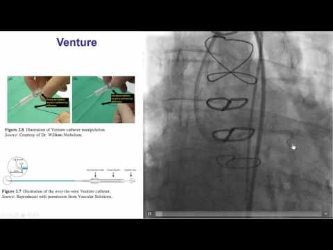 Case 48: Manual of CTO Interventions - Left main and circumflex CTO