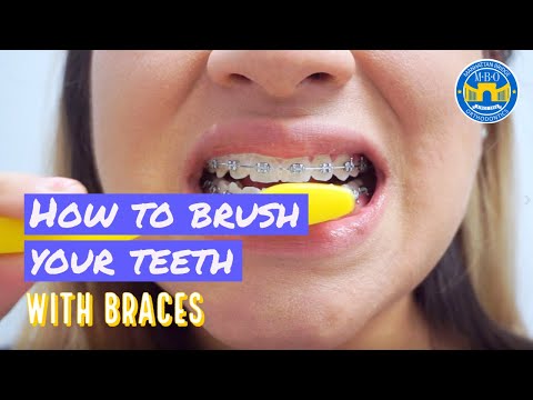 How to Brush with Braces? - 3 Brushing Tips