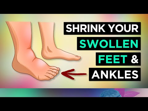 How to Get Rid of Swollen Feet & Ankles Fast: 6 Tips