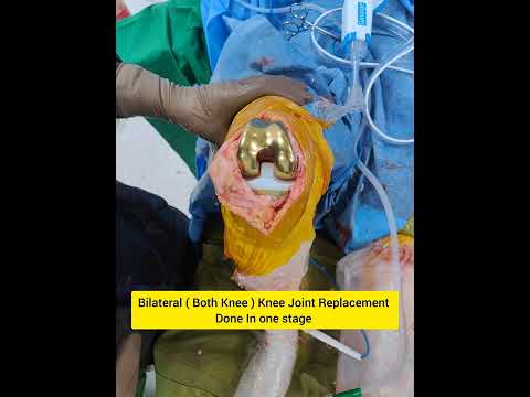 Total Knee Replacement - GOLD - BOTH KNEES - Single Stage