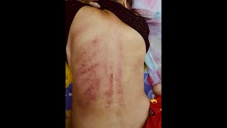 Download lagu Cạo gió cho Bà Ngoại Full lưng ☹️ - Kerokan - Guasha mp3 Download lagu Cạo gió cho Bà Ngoại Full lưng ☹️ - Kerokan - Guasha mp3