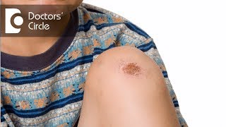 Causes &amp; management of scabs all over the body - Dr. Rasya Dixit