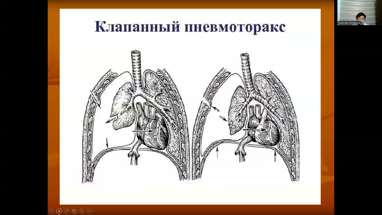 Ko'krak qafasidagi og'riq sindromini differensial diagnostikasi