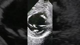 Download lagu LV Contractility #2decho #ejection #LVEF.... mp3 Download lagu LV Contractility #2decho #ejection #LVEF.... mp3