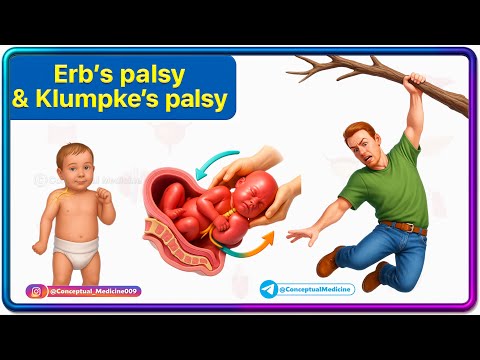 Erb's and klumpke's Paralysis Anatomy Animation / Brachial Plexus injuries