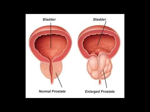 Prostaplant Bewertungen von Ärzten Wie viel sollte Leukozyten Prostata sein