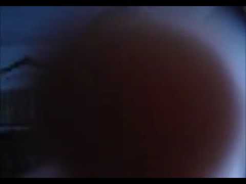 L MENXR en sus comienzos