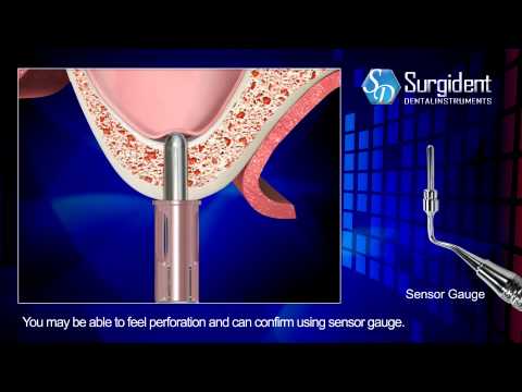 TOCA Kit Sinus Lift Crestal Approach Kit